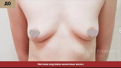 Нитевая подтяжка молочных желез (3)
