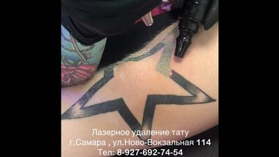 Лазерное удаление татуировок в Самаре - Laser Freestyle